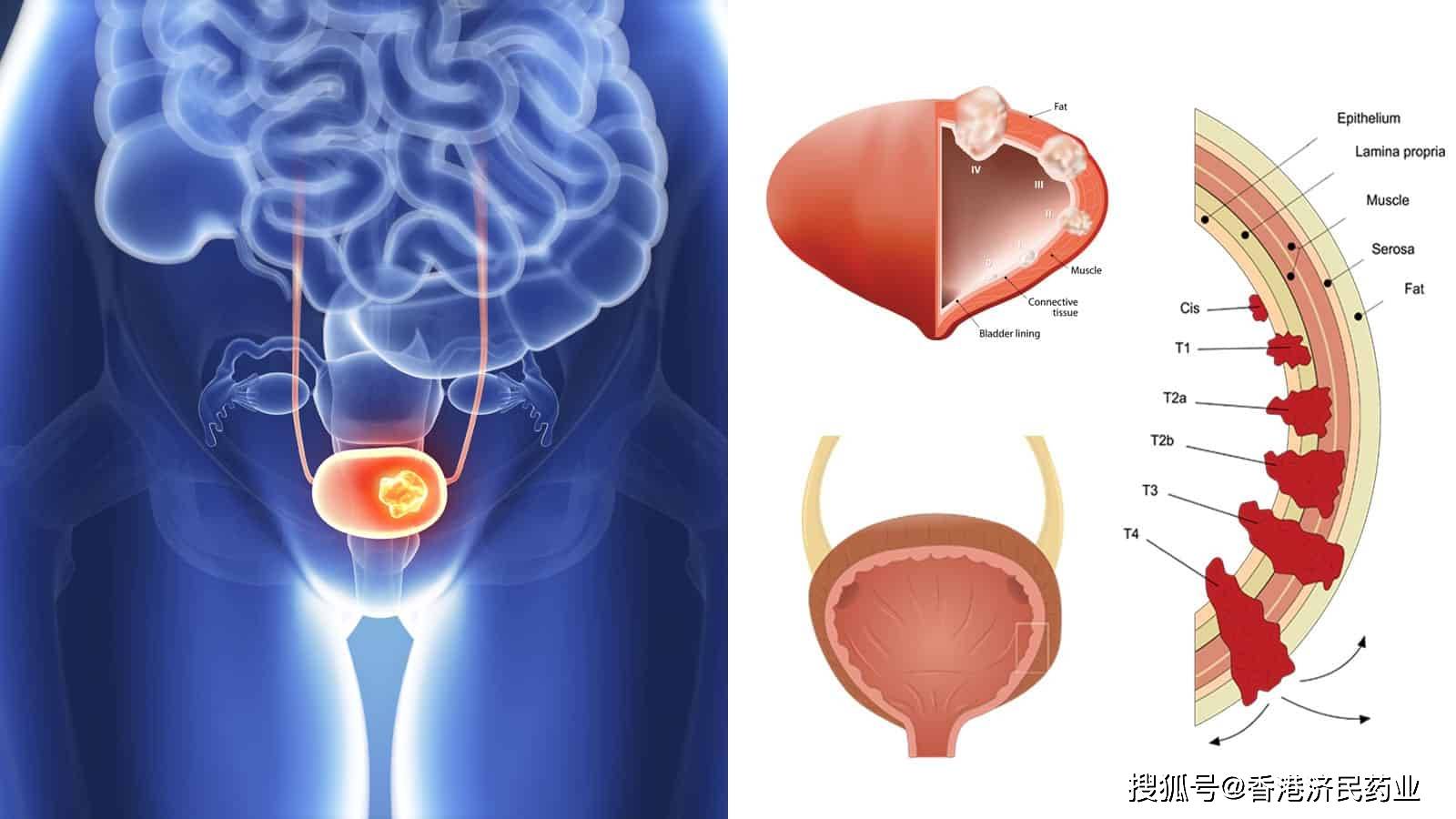 膀胱癌-1.jpeg