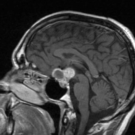 Craniopharyngioma.jpg