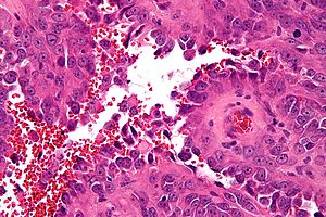 Angiosarcoma - Libre Pathology