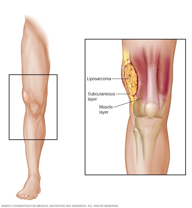 Liposarcoma - Symptoms and causes - Mayo Clinic