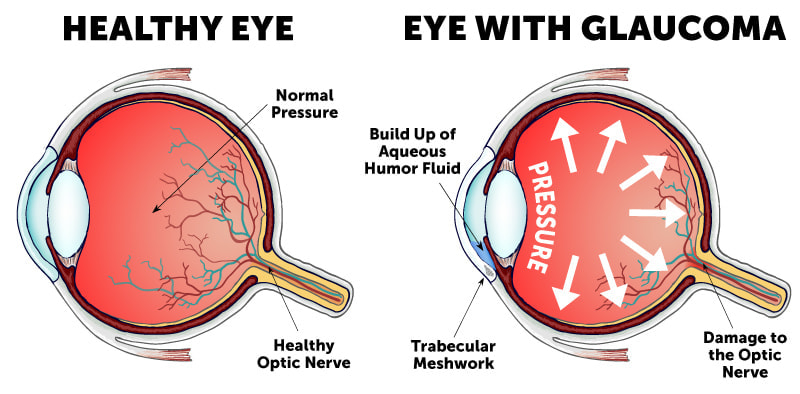 Types of Glaucoma | Wolfe Eye Clinic | Glaucoma Specialists