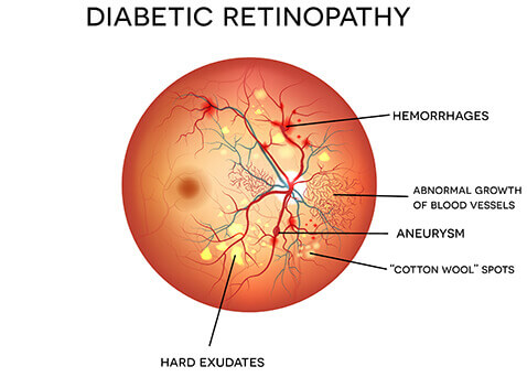 Diabetic Eye Disease Manchester | Diabetic Retinopathy Nashua