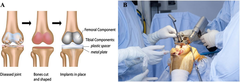 Frontiers | Current advancements in therapeutic approaches in orthopedic  surgery: a review of recent trends