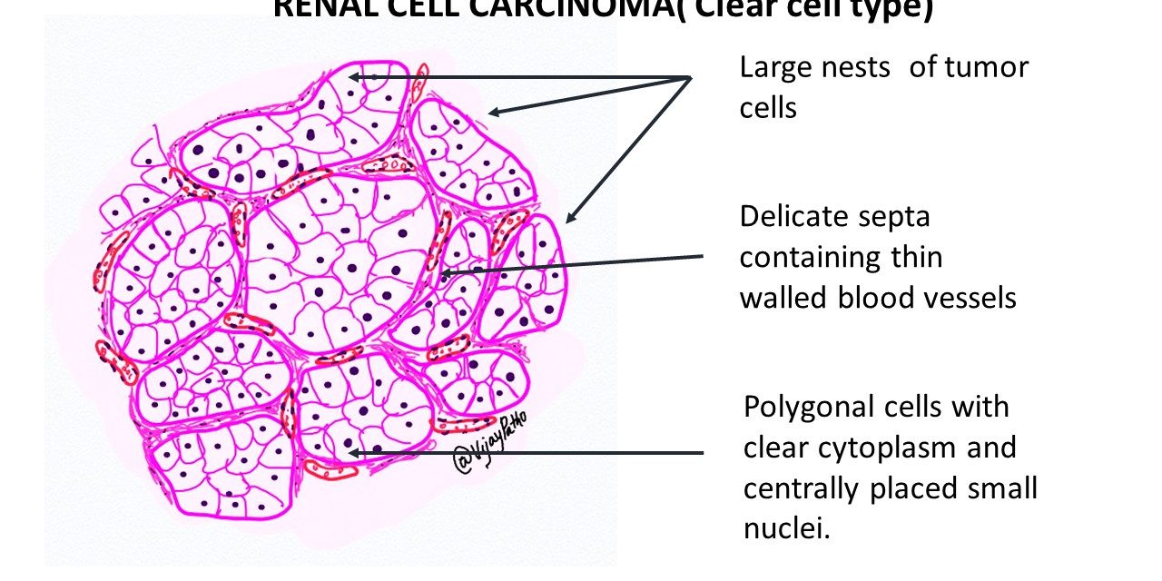1776780441491104.jpg 肾透明细胞癌-pathology made simple.jpg