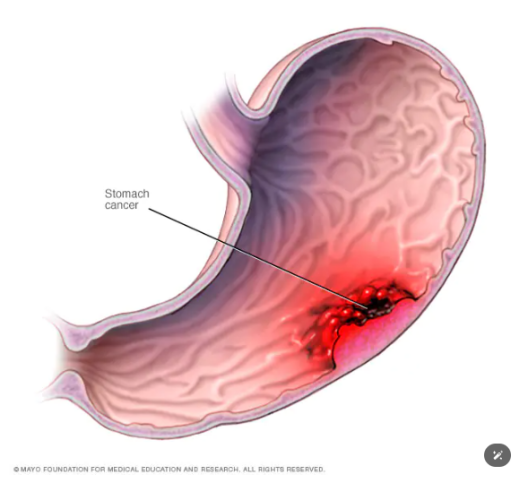 梅奥诊所：治疗胃癌的新化疗方法