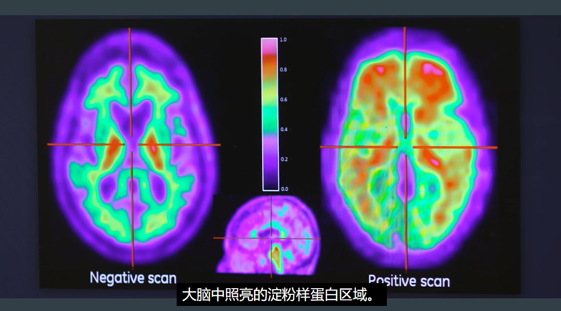 去美国看病，麦克莱恩医院阿尔茨海默患者案例