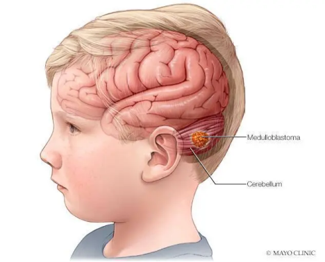 美国治疗儿童髓母细胞瘤的研究进展