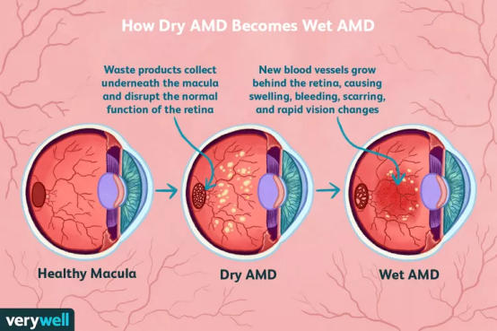 黄斑变性美国看病：AMD的新兴疗法和新研究