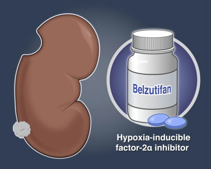 出国看病新资讯： FDA批准Belzutifan 用于治疗晚期肾癌患者